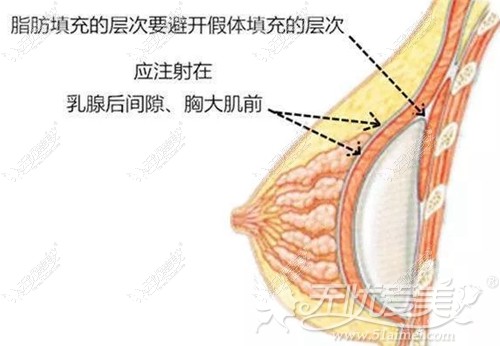 成都铜雀台假体隆胸手术的位置