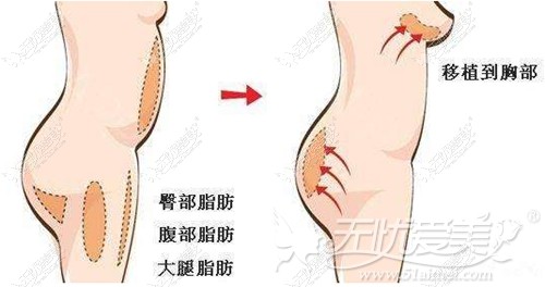 成都铜雀台自体脂肪丰胸