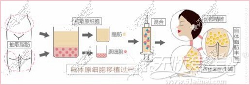 乌鲁木齐黎美自体脂肪丰下巴