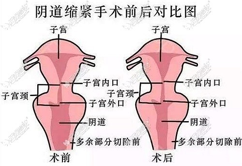 缩阴手术前后效果对比