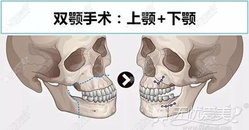 什么情况需要做双鄂手术