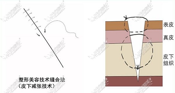 李劲良做鼻小柱修复的优势