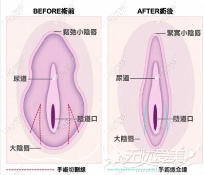 焦作时代女子医院阴唇肥大缩小手术