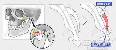 无切除提升颧骨缩小术原理