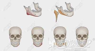 下颌角缩小术的原理