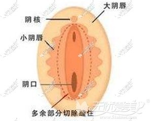 长沙爱思特阴蒂阴唇缩小术