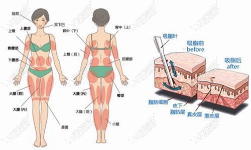 长春铭医吸脂术适合部位