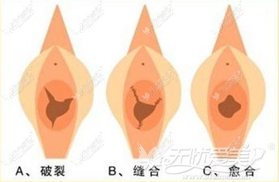 福州台江处女膜修复手术效果