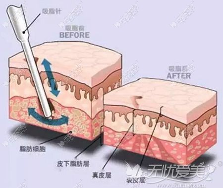 佛山曙光金子水动力吸脂