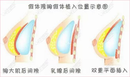 江苏施尔美隆胸假体植入位置