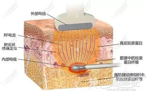 激光溶脂瘦手臂的原理