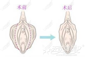 昆明梦想阴唇缩小术