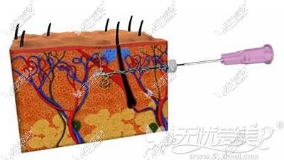 线雕面部提升的原理