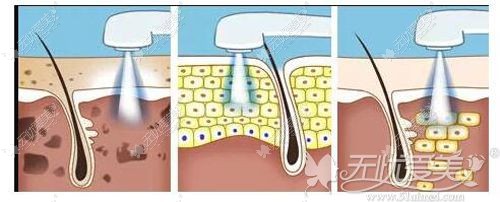光子嫩肤的原理