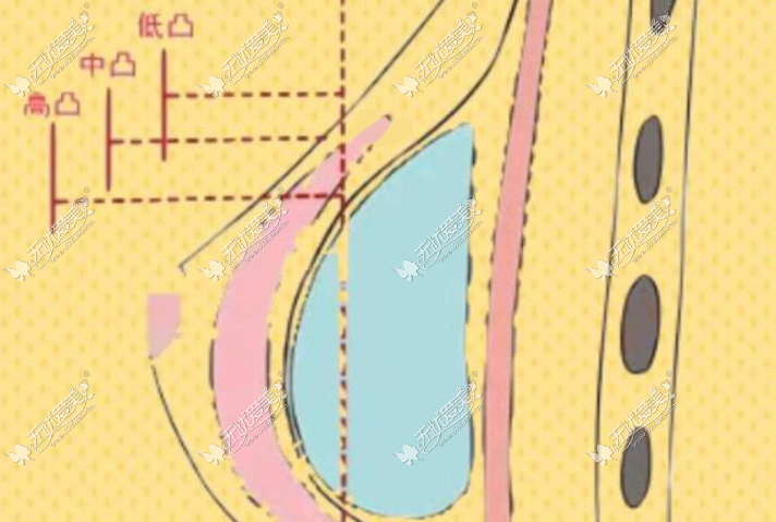 曼托隆胸中凸和高凸的对照图