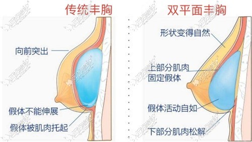 双平面隆胸假体放置的位置