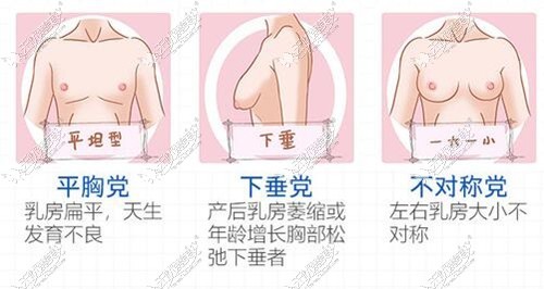 双平面隆胸能解决的问题