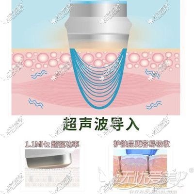 安琪儿整形超声波祛眼袋原理