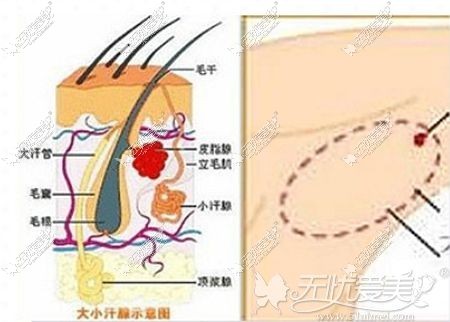 腋臭切除手术的切口