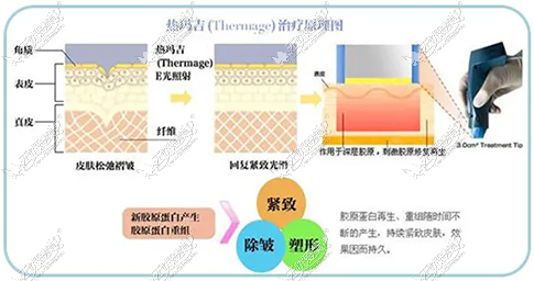 热玛吉去除法令纹