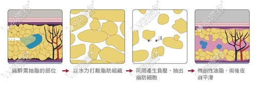 章小平吸脂