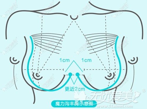 南宁东方魔力沟深V复合隆胸美学标准