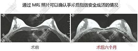 四川美莱自体脂肪隆胸脂肪存活率