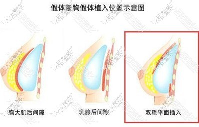 华美紫馨双平面隆胸