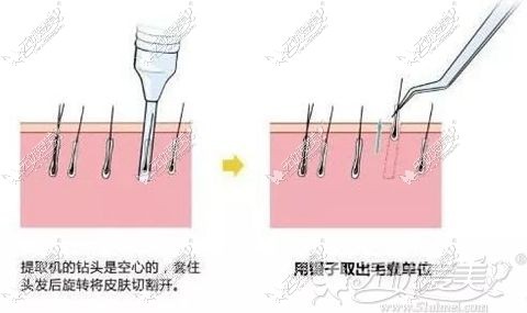 沈阳城本显微植发技术