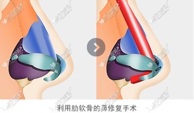 4月31日整形外科鼻修复手术