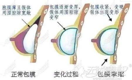 隆胸假体包膜挛缩