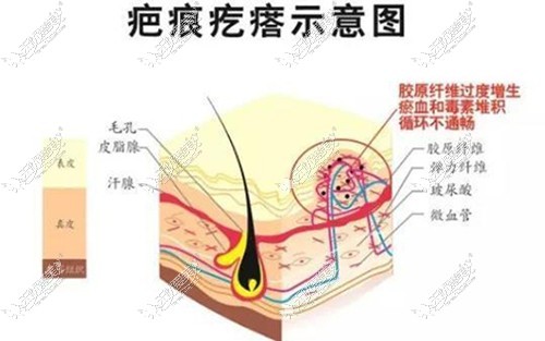 疤痕疙瘩示意图