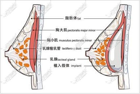 重庆好美整形刘正茂丰胸技术怎么样