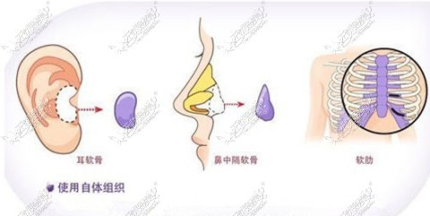 软骨隆鼻