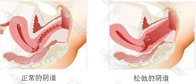 韩国好手艺妇科医院阴道紧缩术