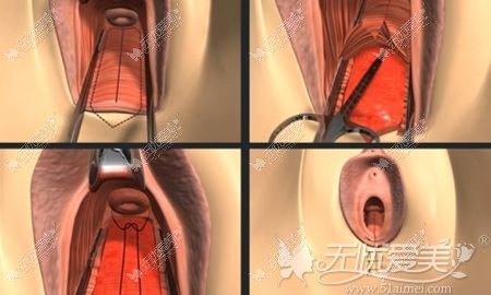 韩国后方膣圆盖术过程