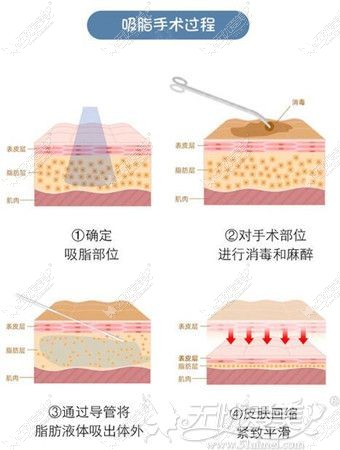 腰腹吸脂手术过程