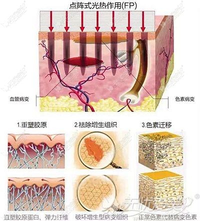 临沂瑞丽激光去疤原理