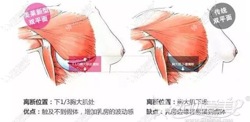 栗勇设计的假体丰胸植入切口