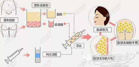 脂肪细胞抽取移植手术过程