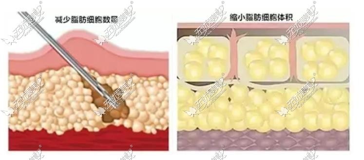 广州曙光吸脂做的好的医生是谁