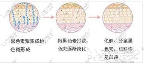 激光祛斑的原理