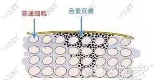 20色素沉淀产生原因