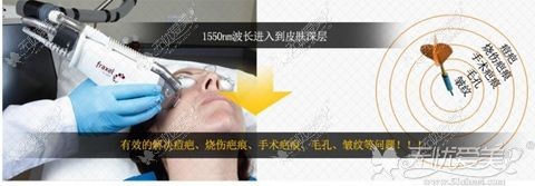 韩国童颜FAXEL1550疤痕激光的优点